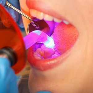 Patient receiving dental bonding | Cleaning, Whitening, Veneers | Best Dentist Andover MA 01810