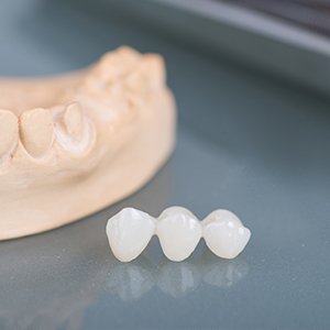 Dental bridge prior to placement | Dental Bridges Andover MA 01810