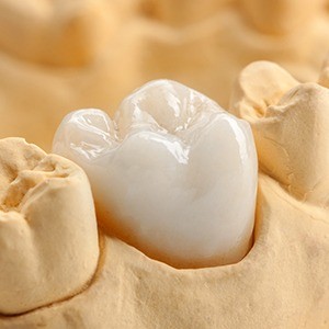 Model smile with dental crown restoration | Dental Crowns Andover MA 01810 Best Dentist
