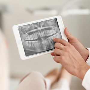 Dental x-rays on tablet computer | Best Veneers, Dental Implants | Dentist Andover MA 01810