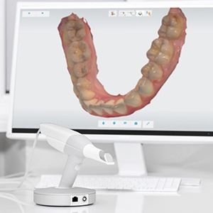 Digital bite impressions on computer screen | Best Same Day Dentist for Tooth Removal Andover MA 01810