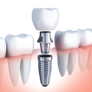 Animation of implant supported dental crown