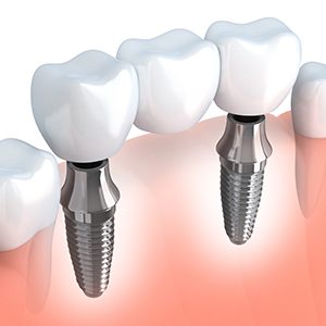 Animation of implant supported fixed bridge