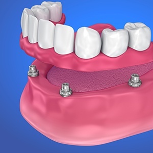 Animation of implant supported denture