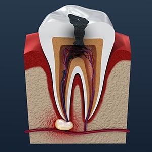 Animation of decay inside the tooth