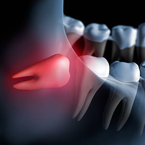 Animation of impacted wisdom tooth