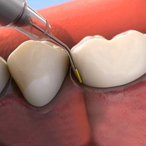 Animation of topical antibiotic placement