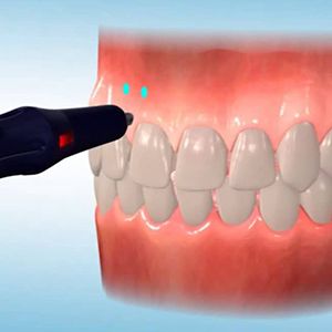 Animation of Propel treatment | Gum Issues and Teeth Straightening | Best Dentist Andover MA 01810